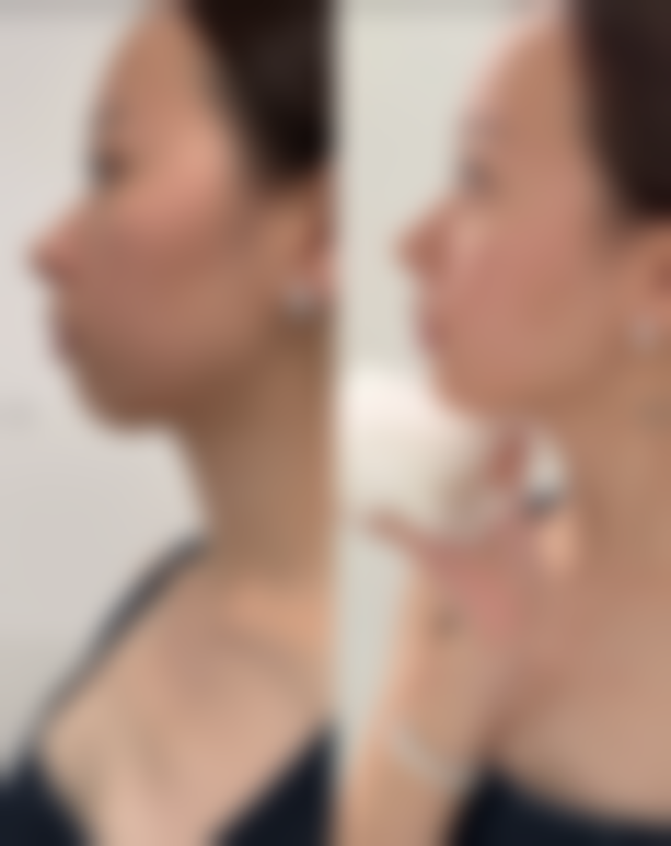 打完瘦脸针晚上怎么睡？选对枕头特别重要