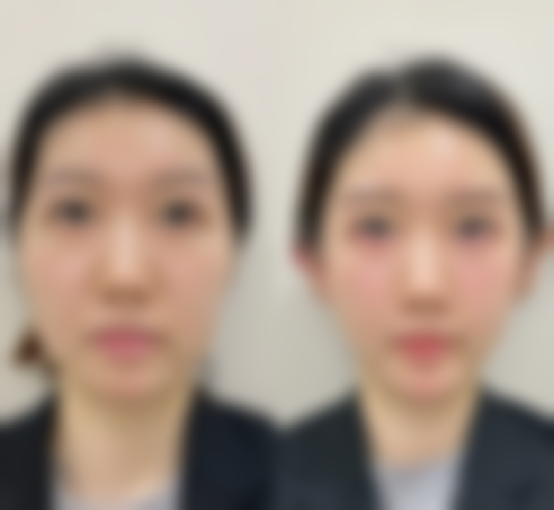 哪些脸型适合打瘦脸针？心形脸打瘦脸针增添魅力