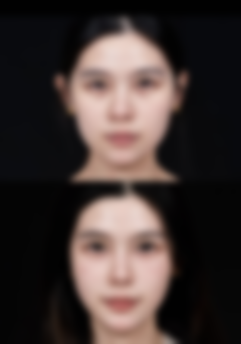 打完瘦脸针晚上怎么睡？这些睡姿可千万别选