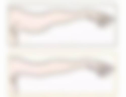 全切双眼皮第八天拆线，专精医生的认可之选