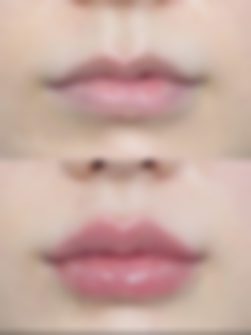 细胞激活祛眼袋究竟是什么？刺激细胞代谢、促进再生，改善多种类型眼袋！ 