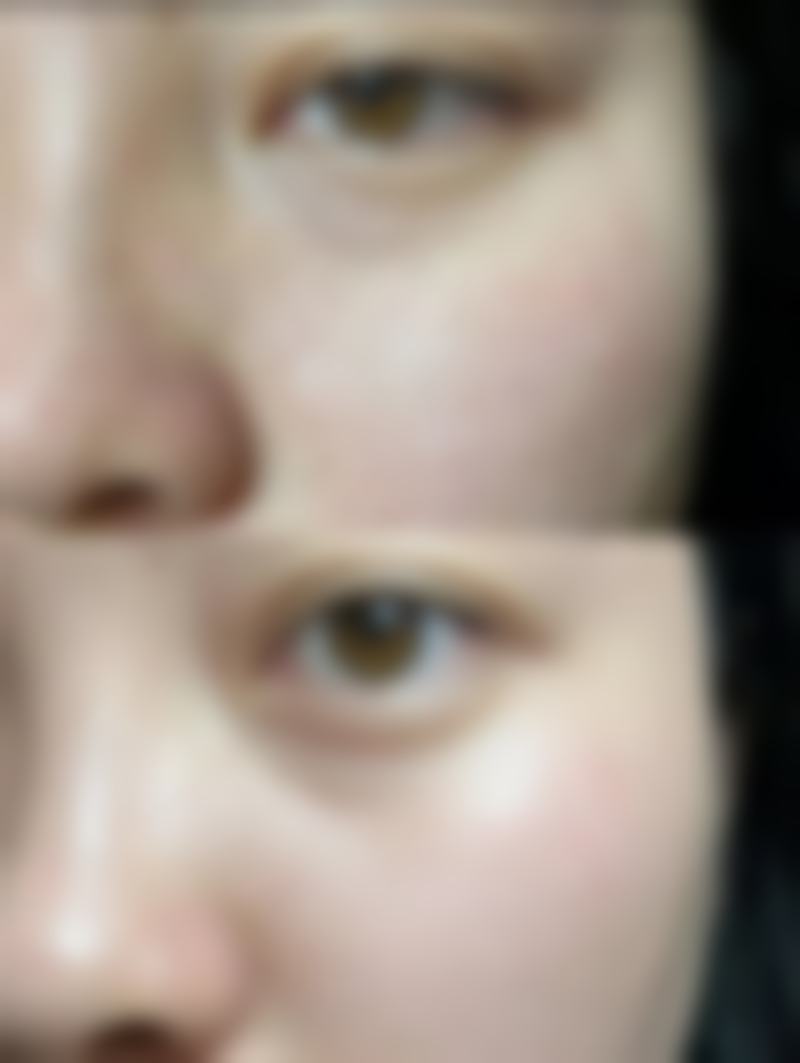 细胞激活祛眼袋：优势大揭秘