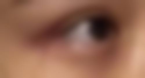 大腿吸脂后如何促进修复，早日同房？