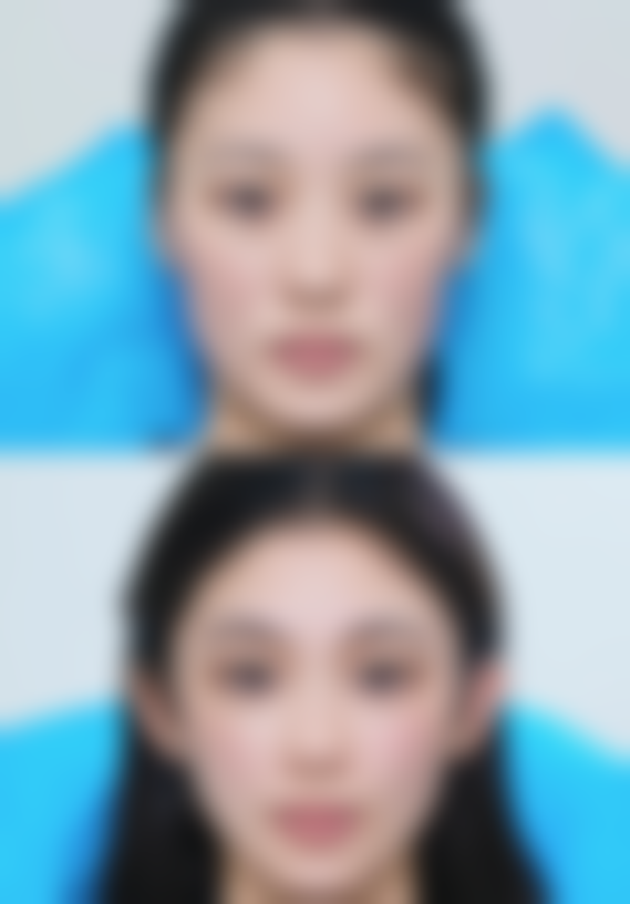 抽脂的风险究竟几何？如何降低风险享受优势