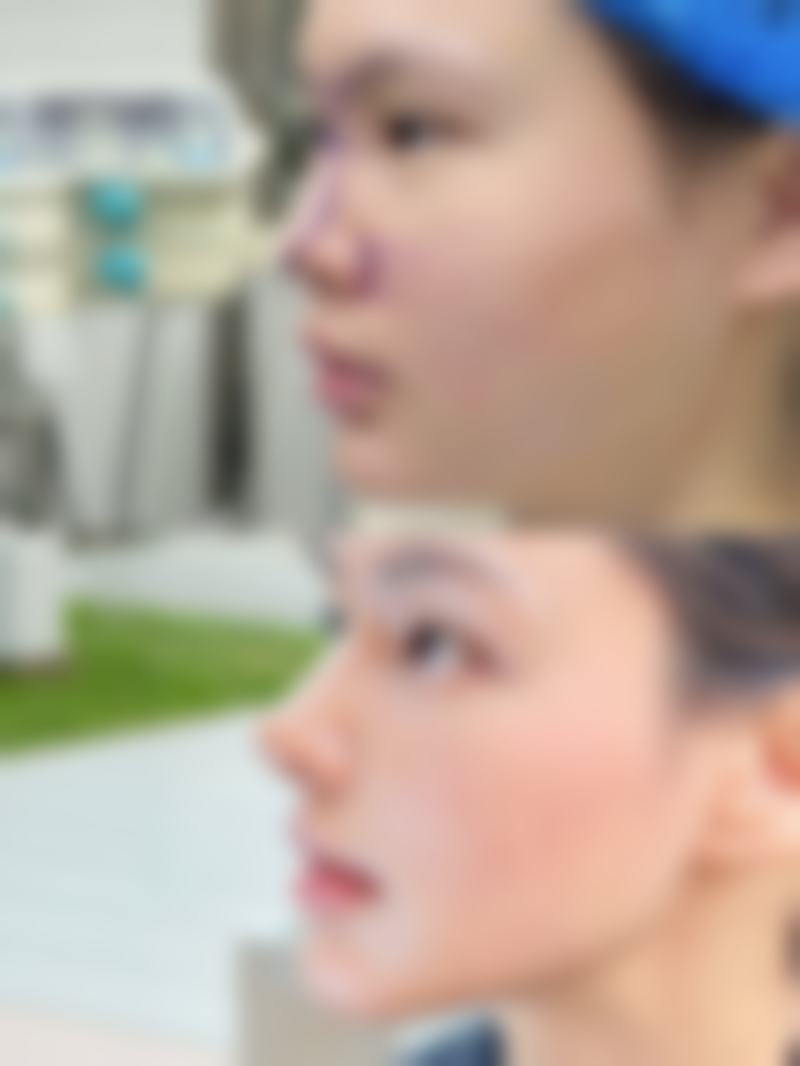 注射玻尿酸隆胸副作用知多少？重度并发症要警惕！