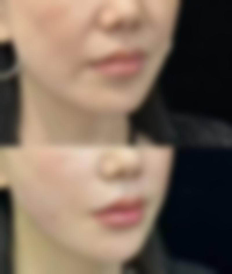 冰敷真能除掉眼袋吗？日常护理配合冰敷