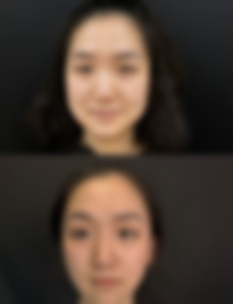 冰敷真能除掉眼袋吗？揭秘冰敷缓解临时眼袋浮肿、辅助术后消肿的实用秘诀 