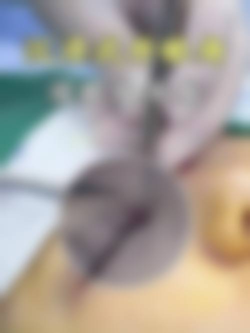 五、济南千慈整形医院实例