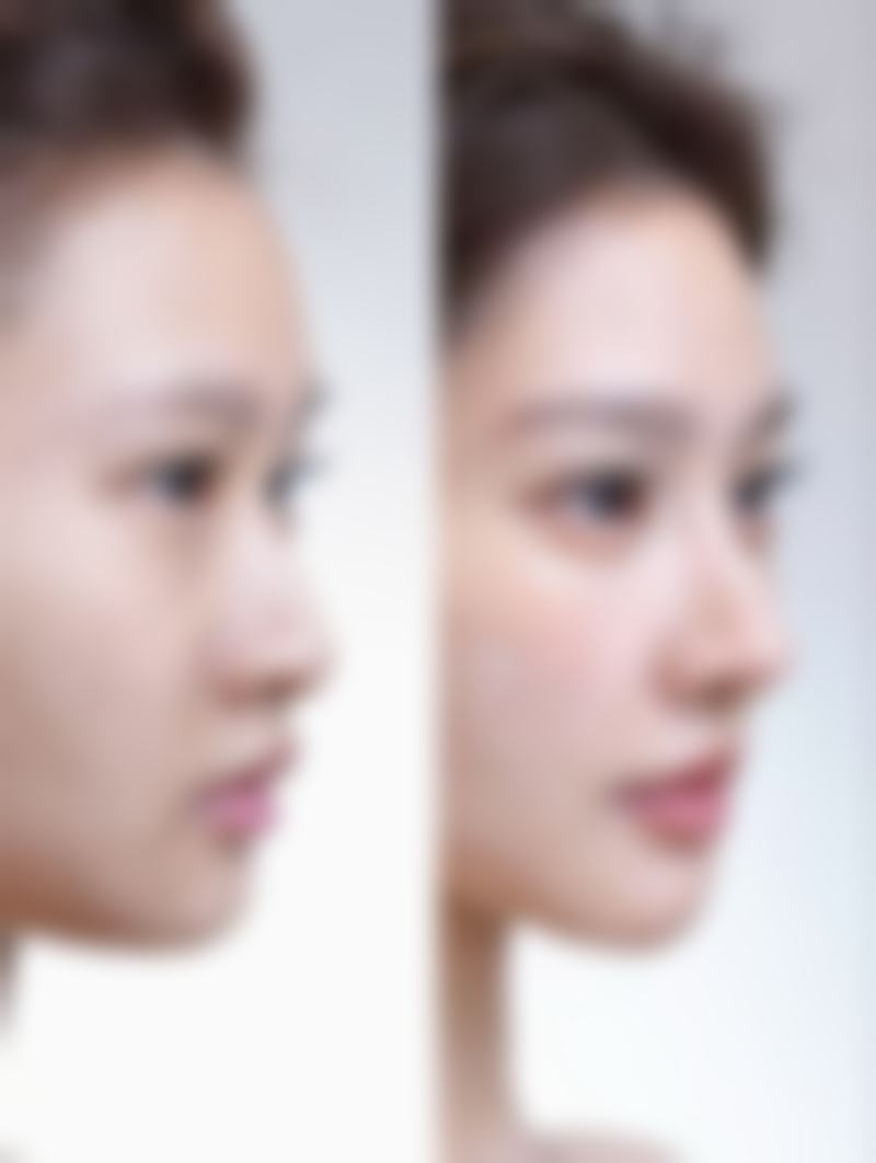 眉毛有疤痕还能长眉毛吗？毛囊状态定乾坤，植眉等方案助你重焕眉彩 