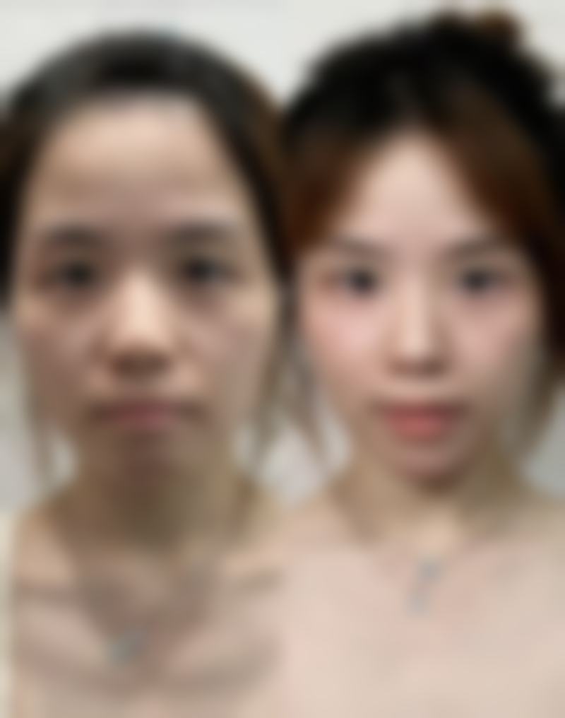选对机构和假体，开启美胸之旅