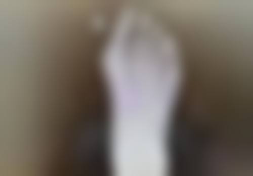 疤痕体质的疤痕能否自行消除？药物治疗辅助改善