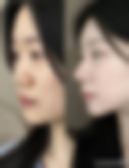 五、肇庆韩婕整形医院实例