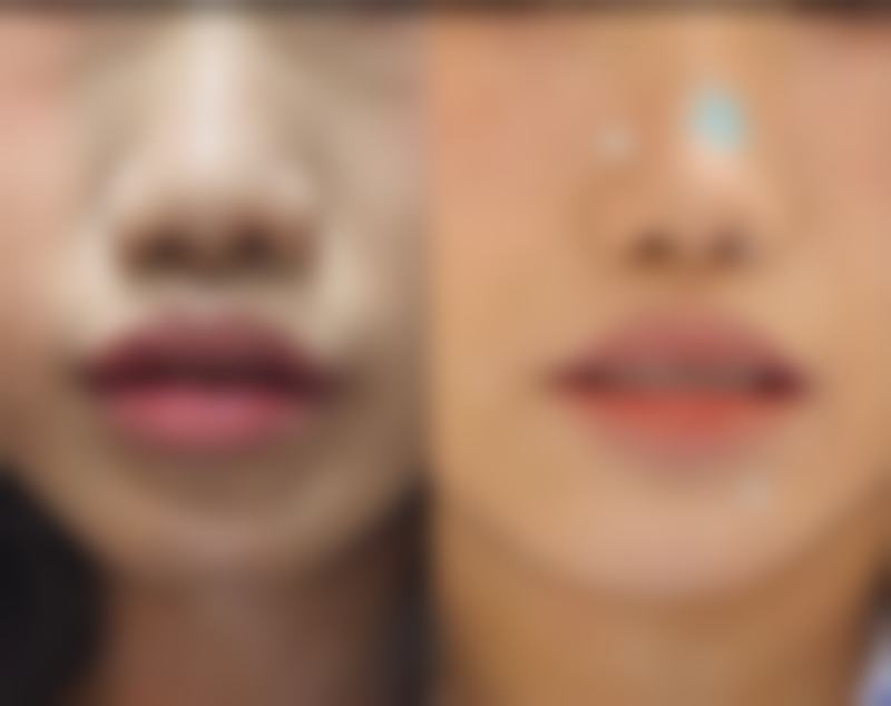 疤痕体质的疤痕能否自行消除？早期干预特别重要