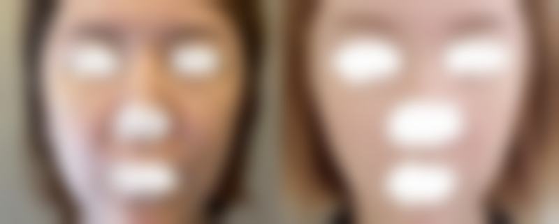 烫伤疤痕印怎么去掉？维生素E的淡印魔法