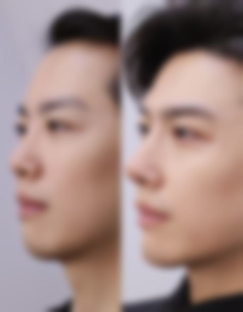 烫伤疤痕印怎么去掉？专精手段之激光治疗