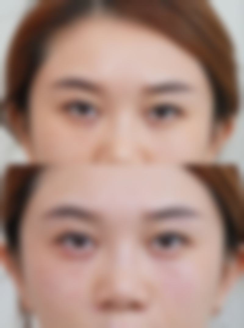 疤痕体质的疤痕能否自行消除？手术治疗及其他治疗方法