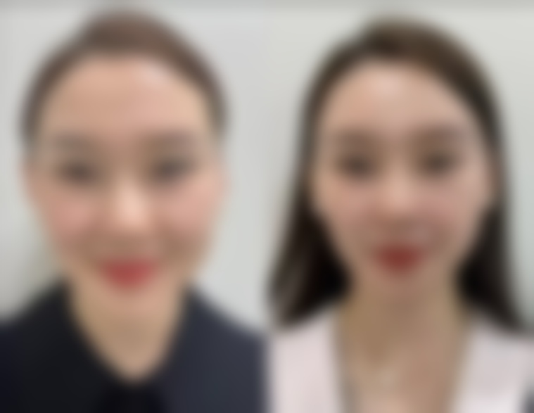 医美治疗方法，快速改善眼周问题