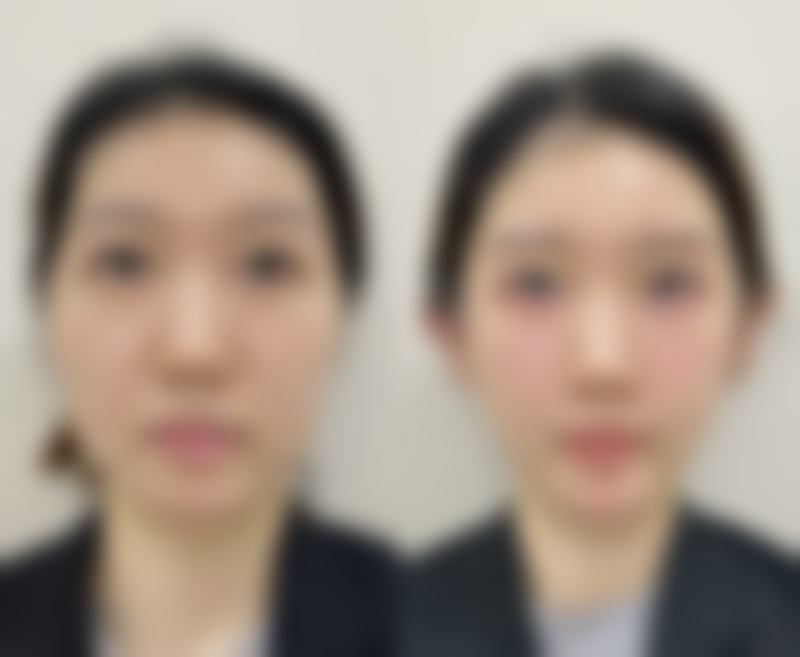宝俪隆胸假体究竟牛在哪？核心优势超突出