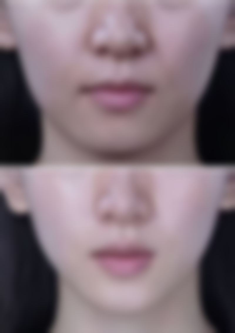 晨起眼睛浮肿眼袋大究竟咋回事？再探病理性因素