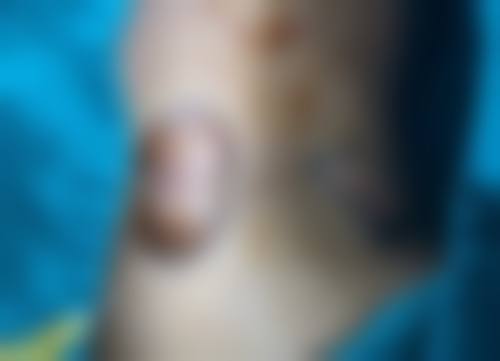 隆鼻成效的长久保护：自体软骨隆鼻的优势