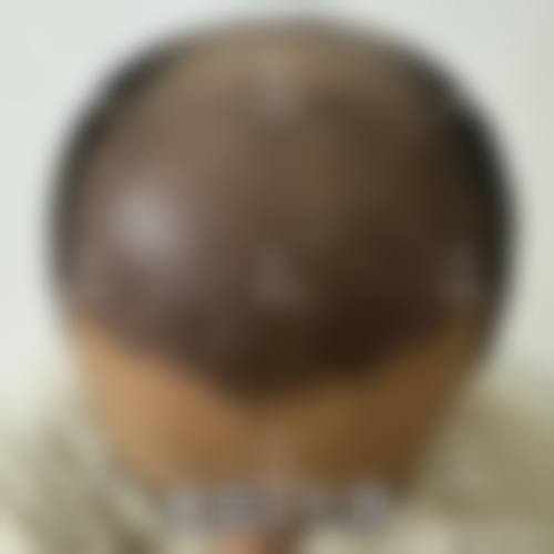 七、新生植发沪浙福连锁价格表：（仅供参考）
