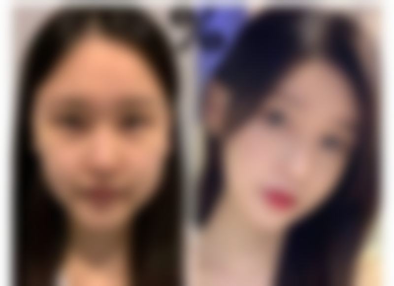 摔伤面部疤痕怎么治?精细护理促修复