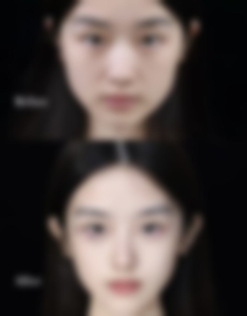 揭秘眼袋突然水肿的原因之过敏反应
