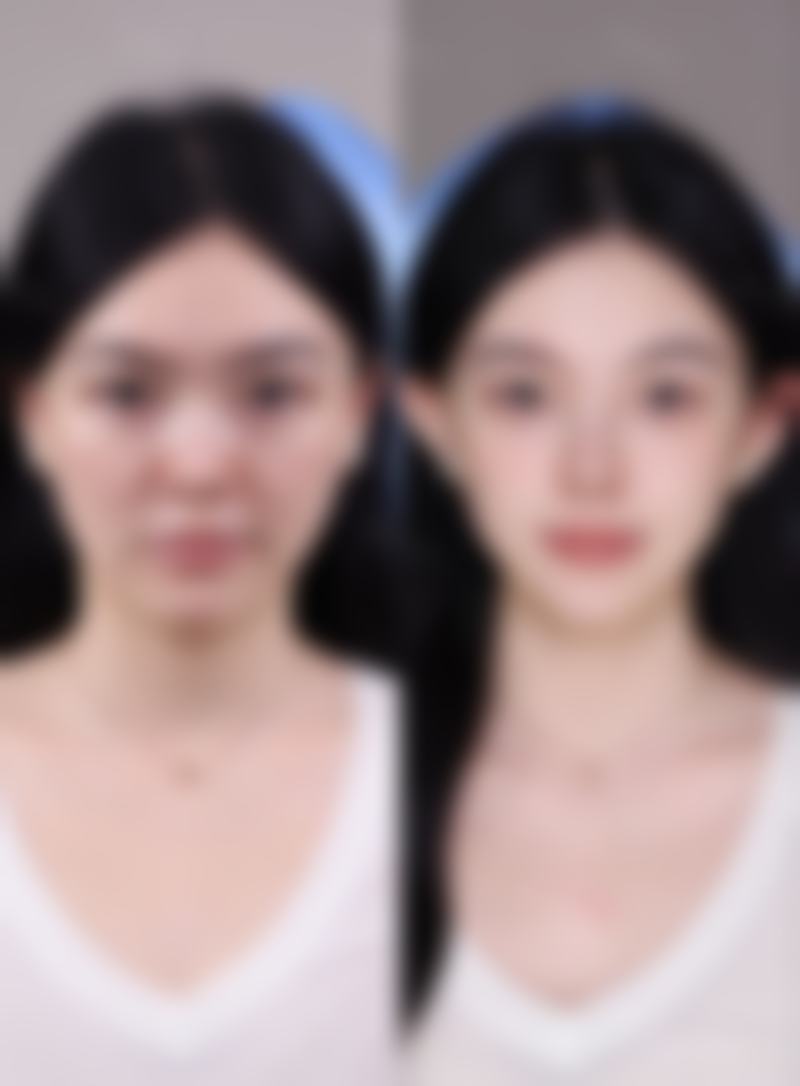 揭秘眼袋突然水肿的原因之眼眶病变