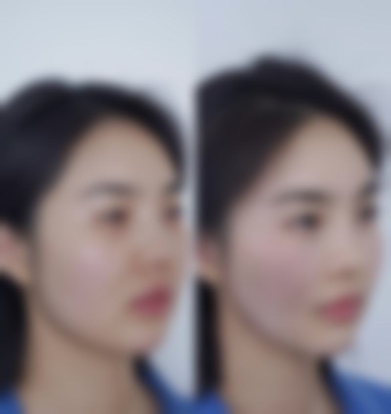 注射式隆鼻成效能维持多久?个体体质因素影响