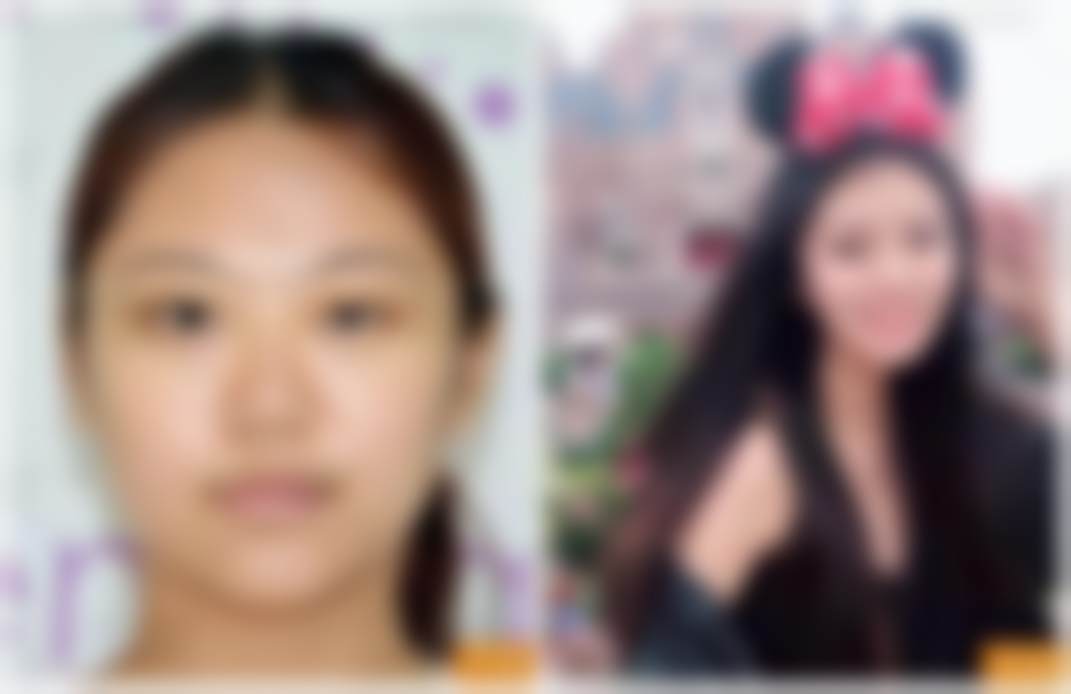 北京禾美嘉医疗美容门诊部李伟民的脂肪丰胸适配判断标准