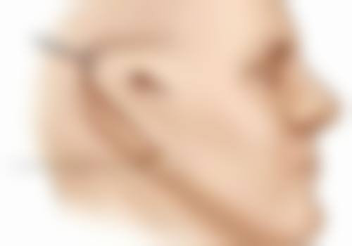 增生疤痕疙瘩该挂哪个科室?总结与提醒