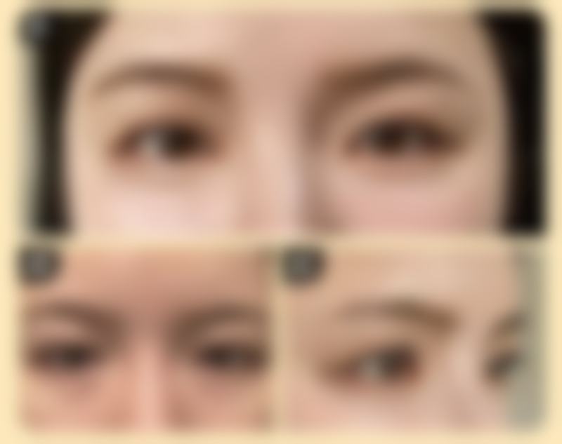 隆胸后腋下疤痕究竟多久能恢复？主流1 - 6个月，做好护理让疤痕更快变淡变软 