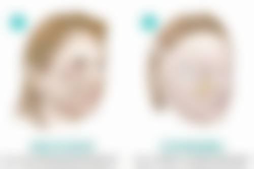 全切双眼皮15天增生,做好日常护理是关键
