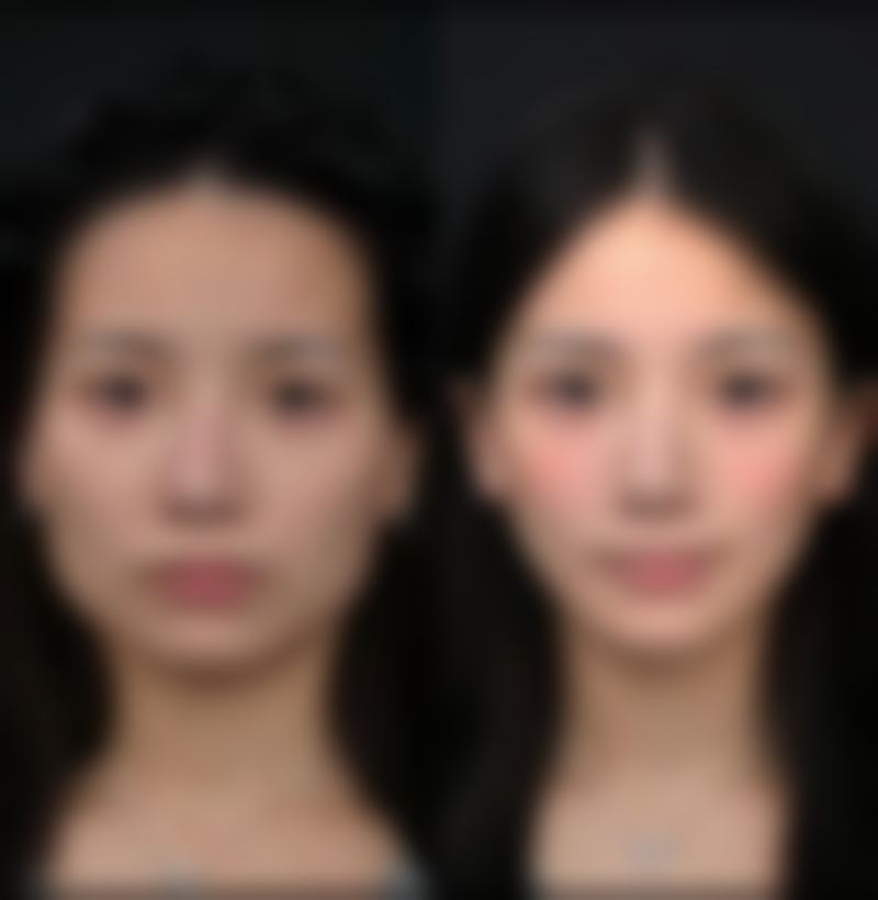 割双眼皮修复时间:个人体质影响大