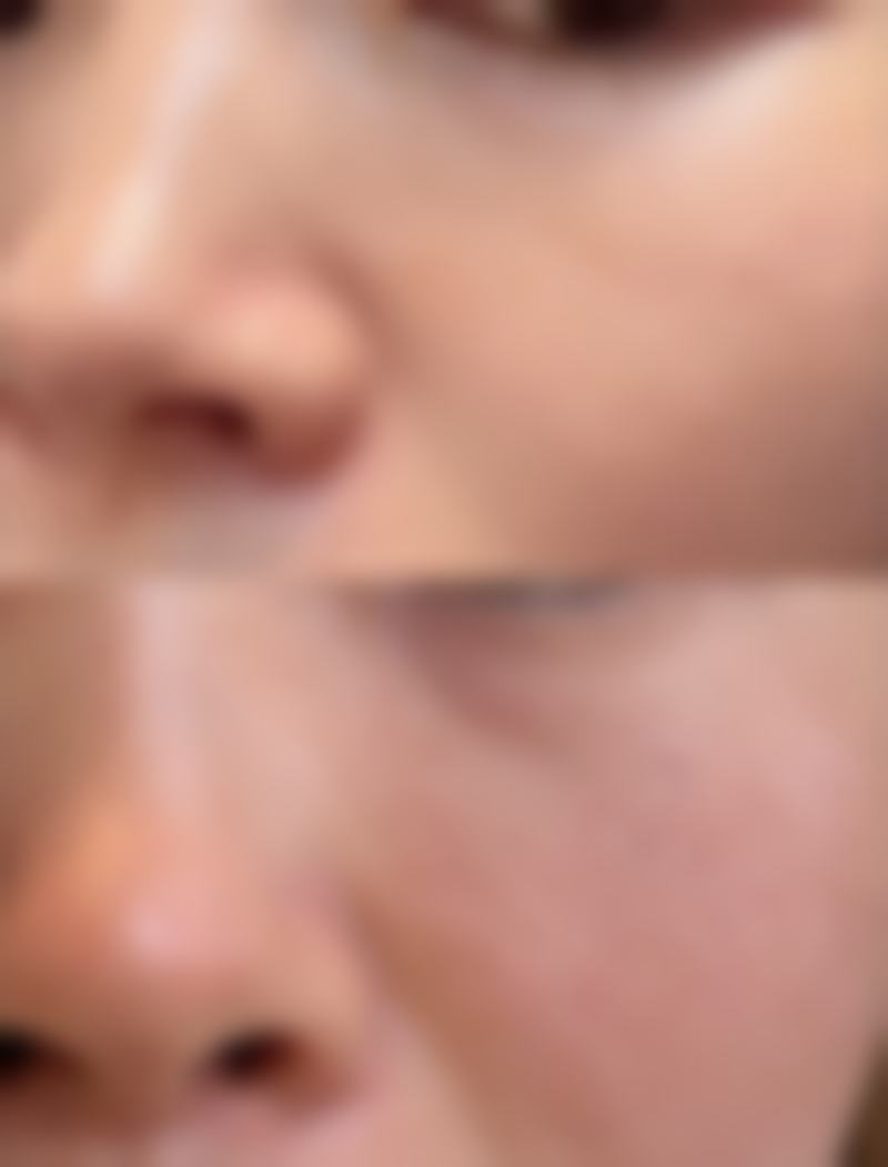 还在为面部疤痕伤脑筋?疤痕预防要做好