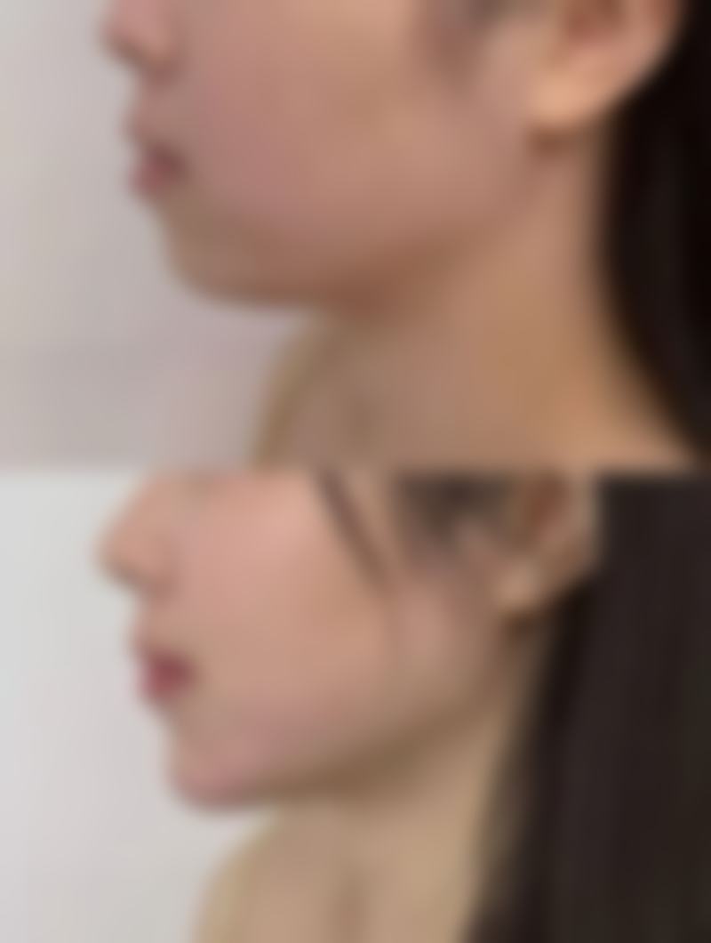 还在愁面部疤痕难去除?居家辅助方法有成效