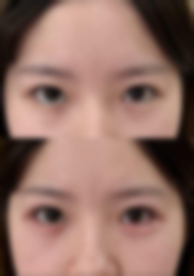 割双眼皮究竟多久能恢复？不同术式、体质及护理下的恢复时间大揭秘 