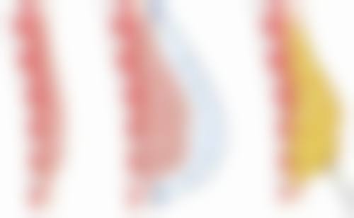 耳软骨隆鼻有哪些不足？取材有限问题需留意
