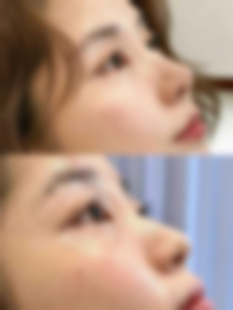 七毫米双眼皮变成内双后如何修复？