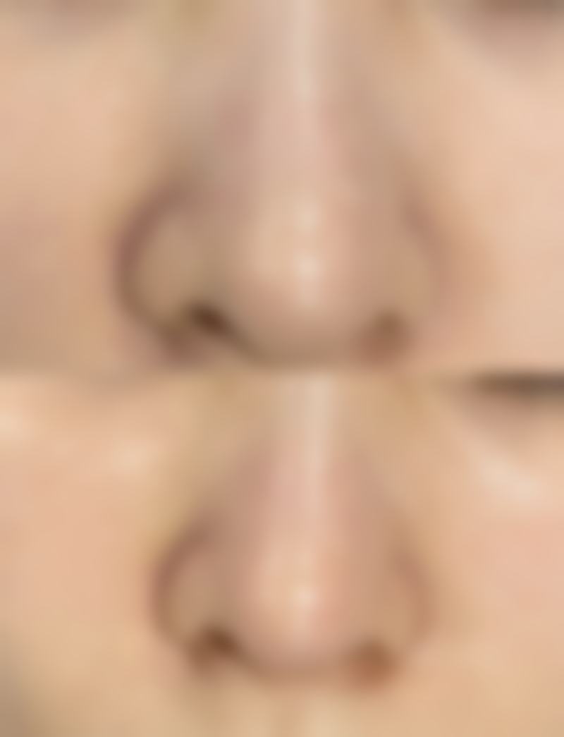 七毫米双眼皮有哪些优势？