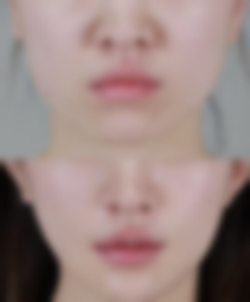 耳软骨隆鼻有哪些不足？支撑力弱问题需重视