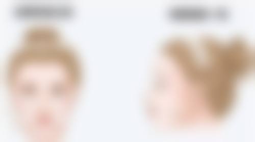 割双眼皮后期有啥副作用?重睑线异常、刀口印记明显别小瞧