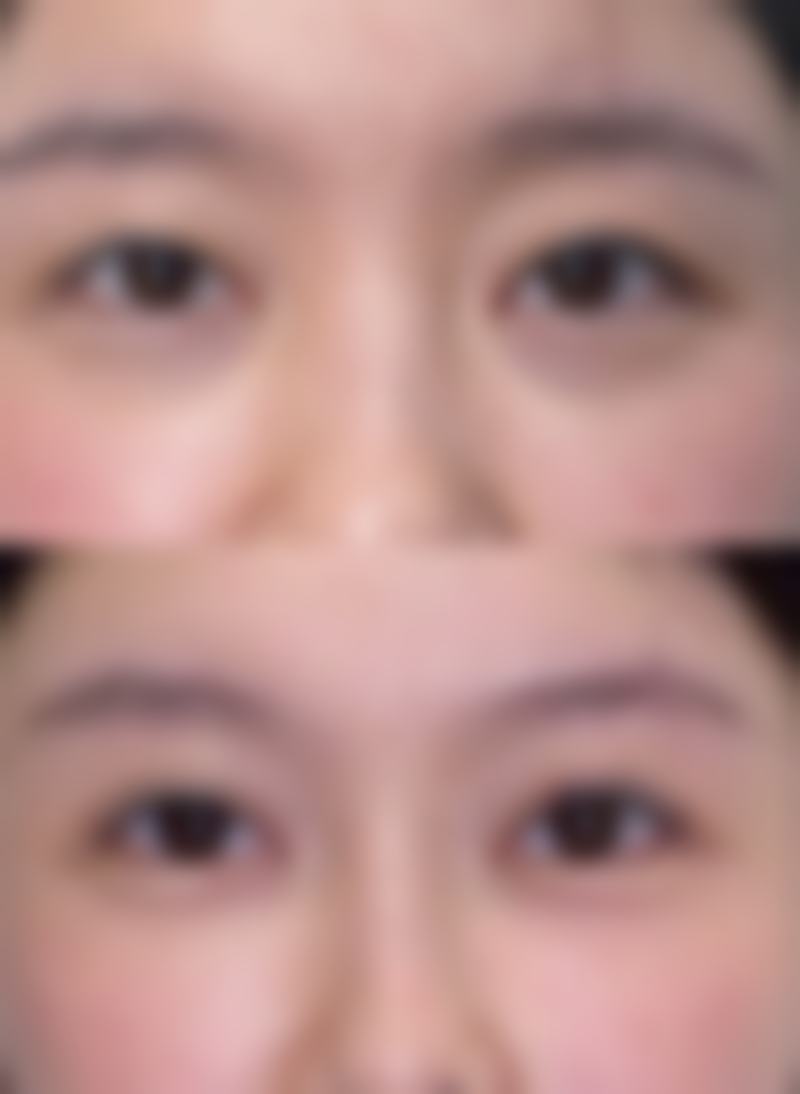 大腿吸脂一月未变细原因揭秘:异常病理情况需警惕