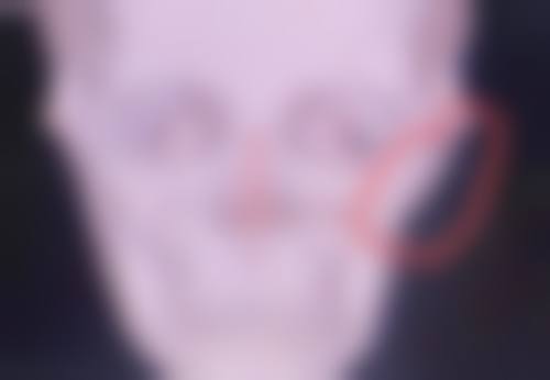 隆鼻后做好护理,避免鼻头歪斜及促进修复