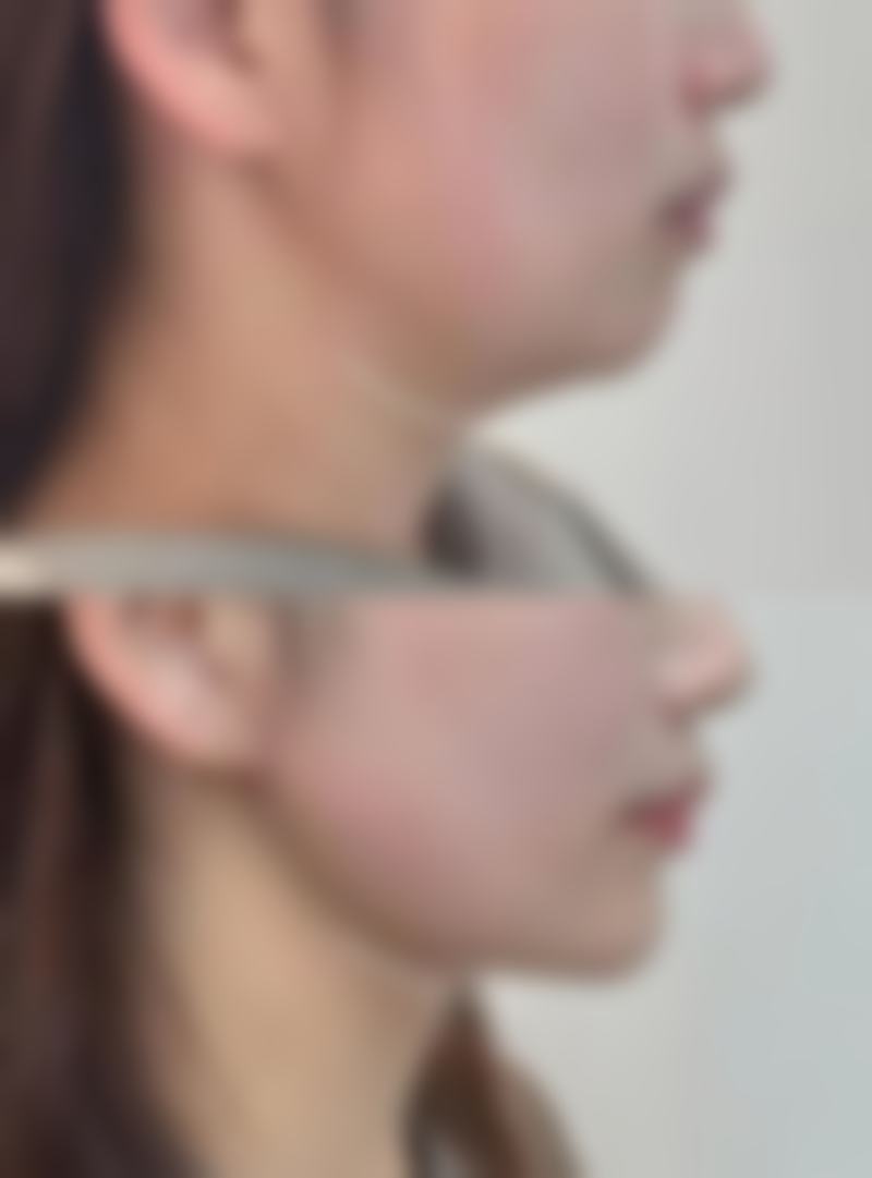 抽脂手术时间究竟几何?特定部位抽脂的时长情况