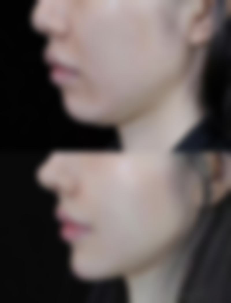 做眼袋手术修复时间大揭秘——通用的修复规律和阶段