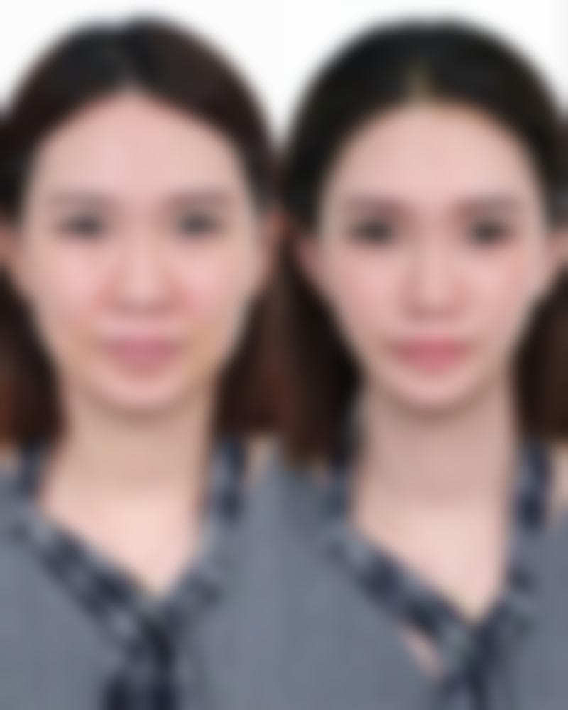 小孩脸被指甲抓伤留疤怎么办？多手段结合，从日常护理到专业治疗消除疤痕 