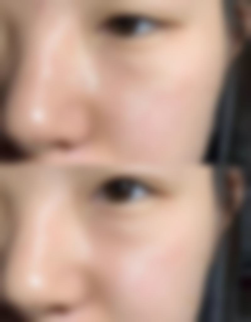 儿童眼袋发青调养之就医干预与日常注意