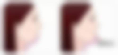 如何辨别：从触感维度感受隆胸与真胸不同