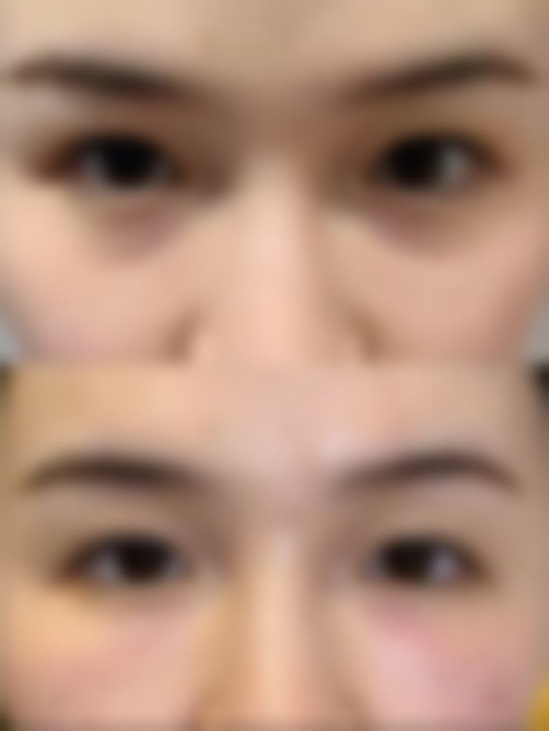 做完双眼皮,个人体质对疤痕修复有啥影响?